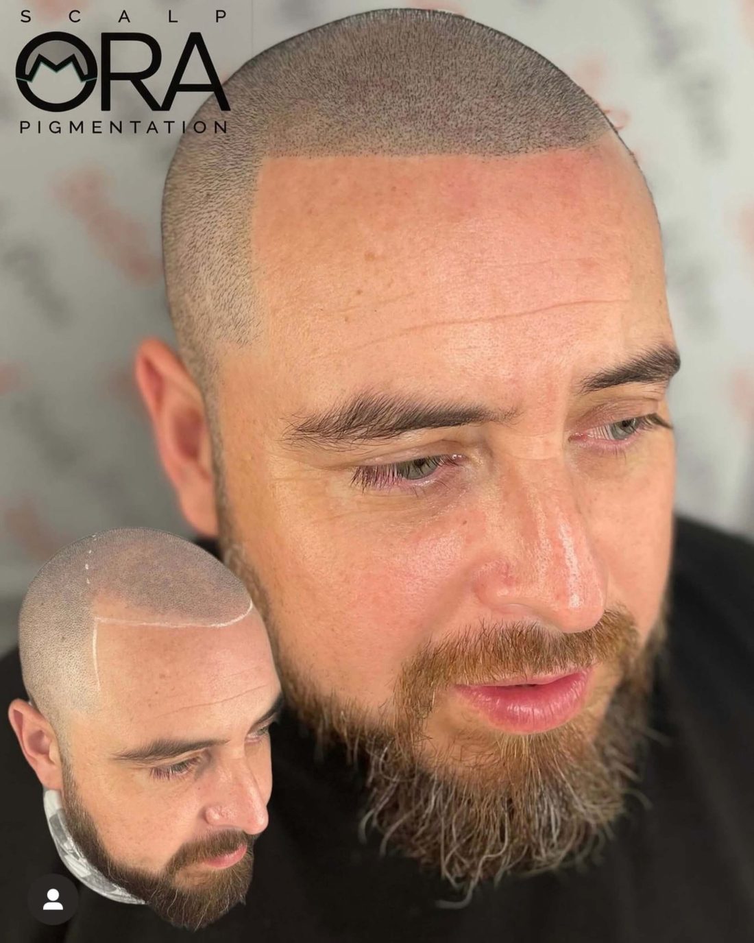 Hairline restoration by Daniel Mora