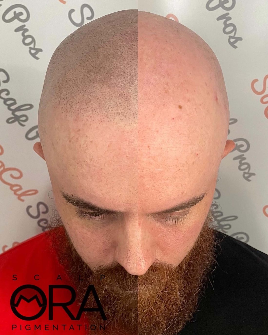 Natural hairline by Daniel Mora