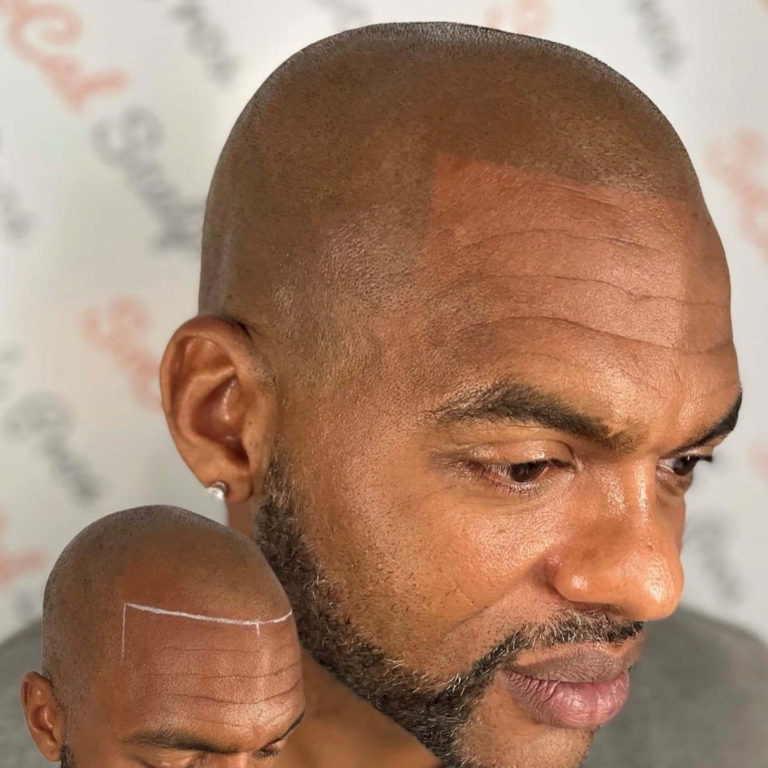 Advanced hairline pigmentation