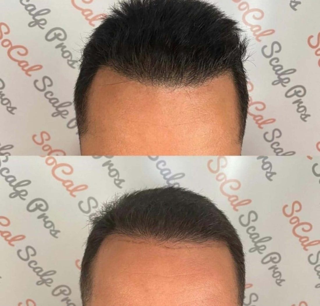 Frontal hairline result